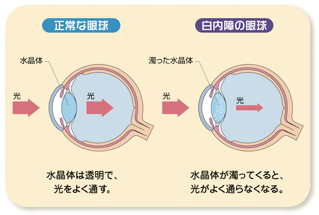 白内障の原因について
