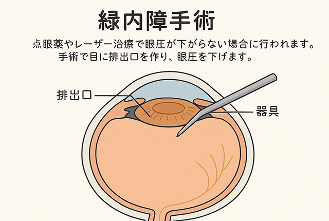 緑内障手術