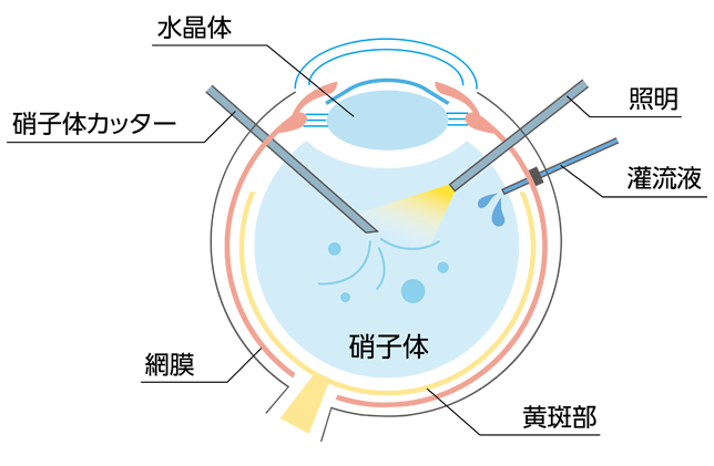 硝子体手術について